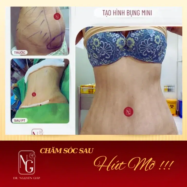 why cham soc after hut mo in