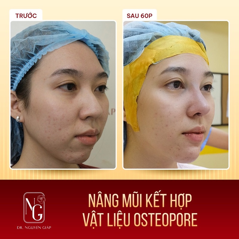 Hình ảnh khách hàng trước và sau khi nâng mũi bọc sụn tại Thẩm mỹ Dr Nguyên Giáp