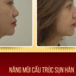 Nâng Mũi Cấu Trúc Mới Giúp Nâng Cấp Dáng Mũi Bền Lâu