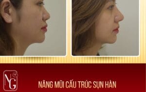 Nâng Mũi Cấu Trúc Mới Giúp Nâng Cấp Dáng Mũi Bền Lâu