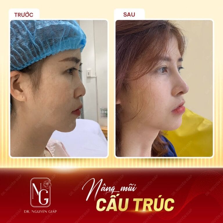 What is structural rhinoplasty? Benefits and standard medical ...