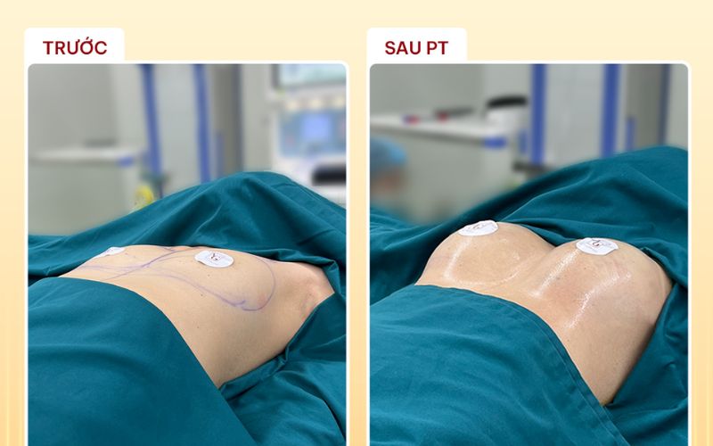 Hình ảnh khách hàng trước và sau khi nâng ngực Nano Chip tại Phòng Khám Dr Nguyên Giáp