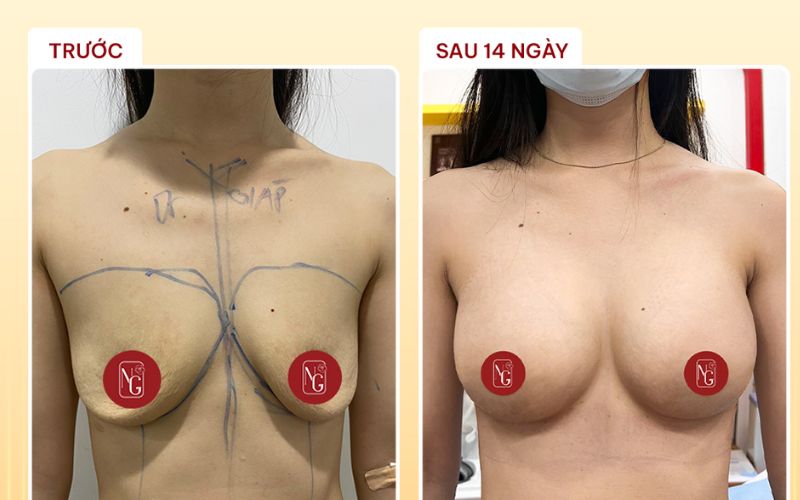 Hình ảnh khách hàng trước và sau khi nâng ngực Nano Chip tại Phòng Khám Dr Nguyên Giáp