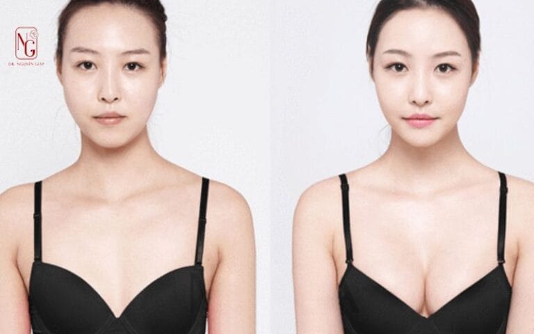 Breast Augmentation Nano Chip - Golden Recipes Ownership Within 1 Sexy