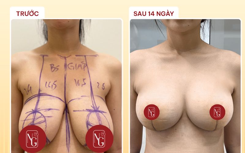 Hình ảnh khách hàng trước và sau nâng ngực Nano chip Ergonomix  tại Phòng Khám Dr Nguyên Giáp