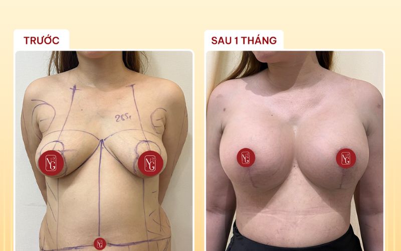 Hình ảnh khách hàng trước và sau nâng ngực Nano chip Ergonomix  tại Phòng Khám Dr Nguyên Giáp