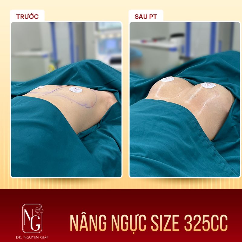Hình ảnh khách hàng trước và sau khi nâng ngực Nano thường tại Phòng Khám Dr Nguyên Giáp