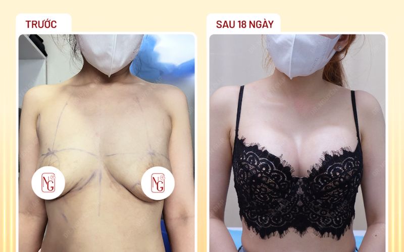 Hình ảnh khách hàng trước và sau khi nâng ngực sửa túi tại Phòng Khám Dr Nguyên Giáp