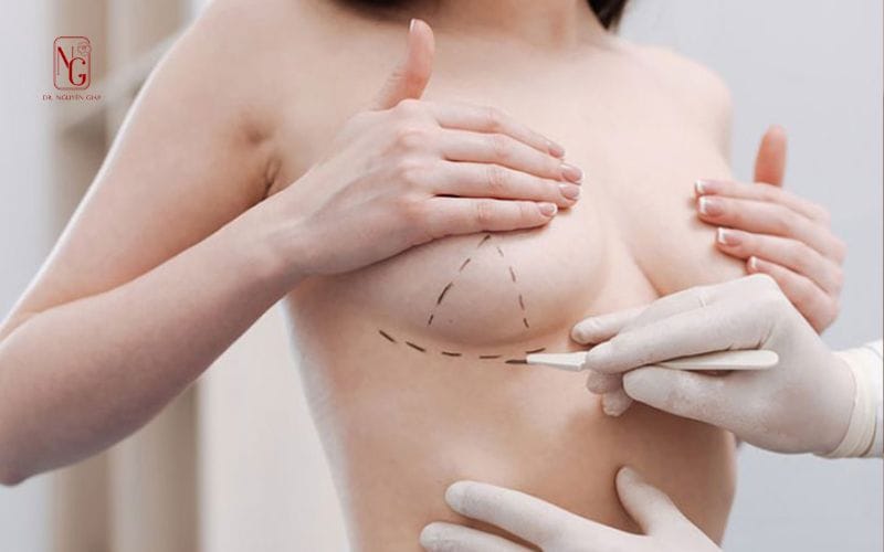 Breast augmentation surgery implant placement