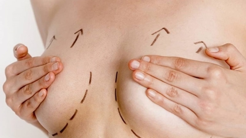Treo sa trễ ngực – giải pháp phục hồi hình dạng ngực tạo đường nét hoàn hảo