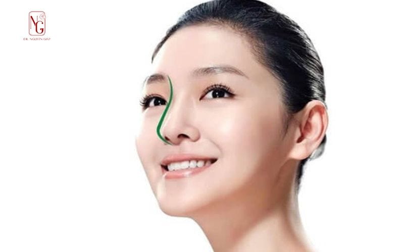 Có Nên Sửa Mũi Không? Những Dáng Mũi Không Nên Sửa