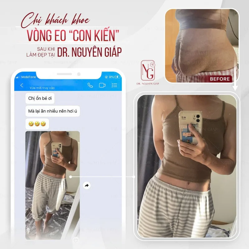 ket qua kh truoc va after hut mo eo