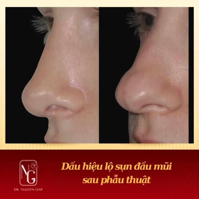 dau hieu lo sun dau mui