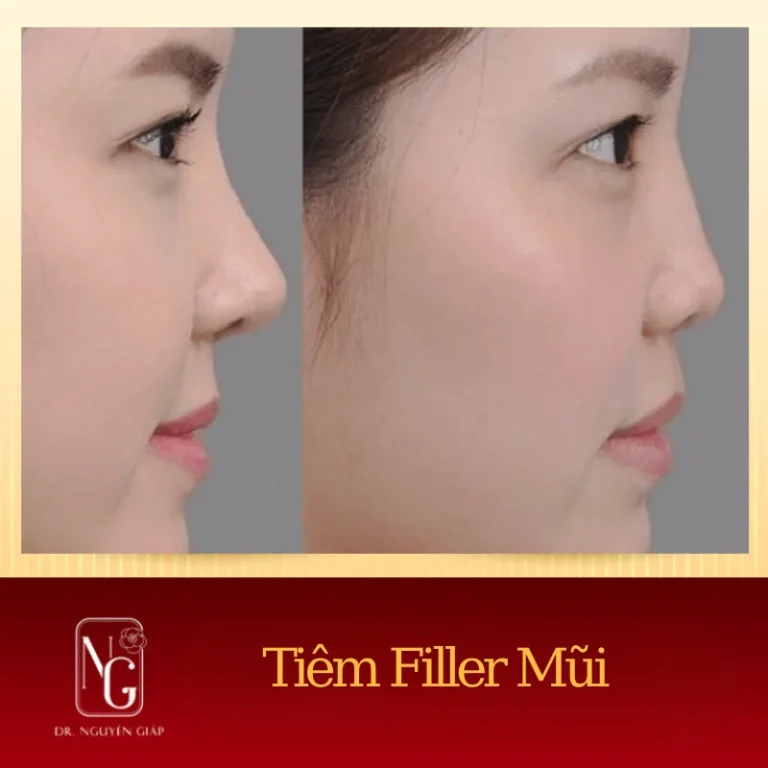 luu y truoc va sau khi tiem filler mui