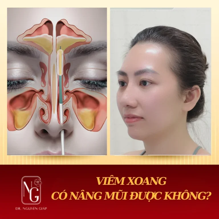 viem sinus cyst hood I