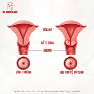 so-do-co-tu-cung-khoe-manh-va-co-tu-cung-co-te-bao-tien-ung-thu-chuan-y-khoa-dr-nguyen-giap Sơ đồ cấu trúc y khoa mô phỏng co tu cung khoe manh va co tu cung co te bao tien ung thu thực hiện bởi Dr Nguyên Giáp
