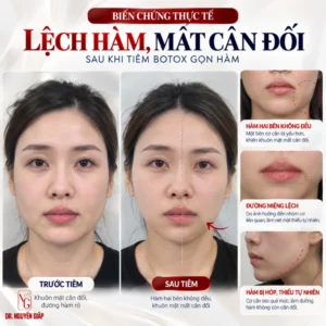 bien-general-lech-ham-mat-close-wife-after-injection-botox-gon-ham Hình ảnh thực tế bien chung lech ham mat can doi sau khi tiem botox gon ham