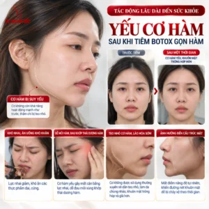 yeu-co-ham-after-injection-botox-gon-ham-tac-teens-wipe-dai-den-suc-khoe Hình ảnh thực tế yeu co ham sau khi tiem botox gon ham tac dong lau dai den suc khoe