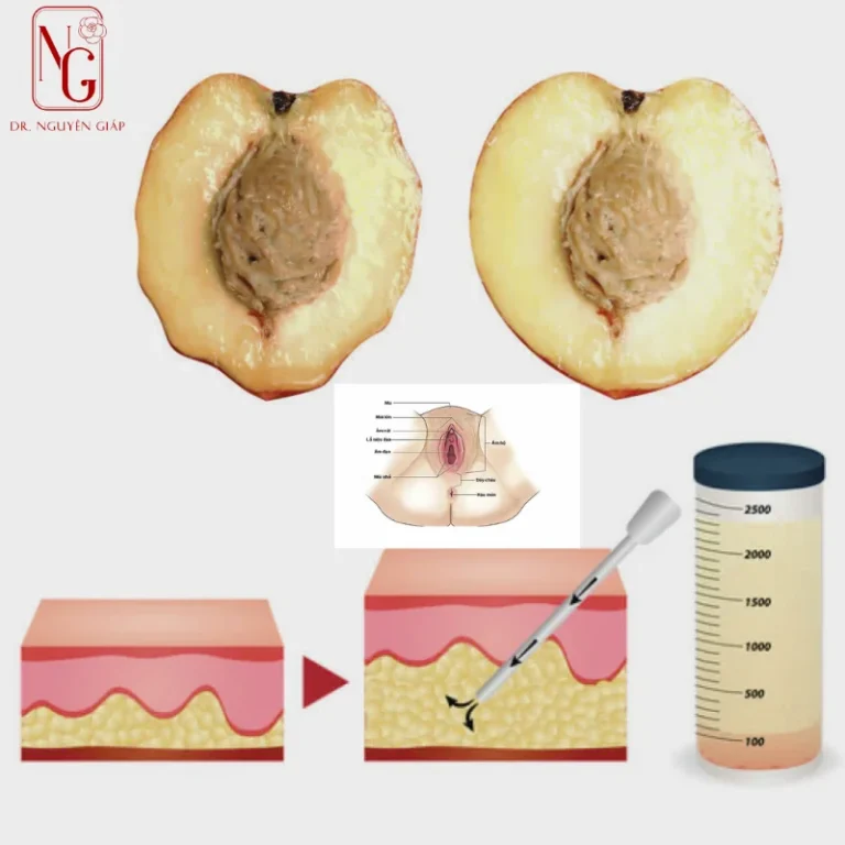 anh truoc va after spicy mo moi lon