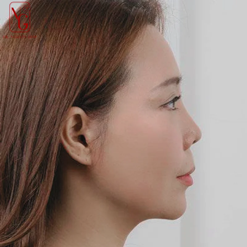 the forehead is concave