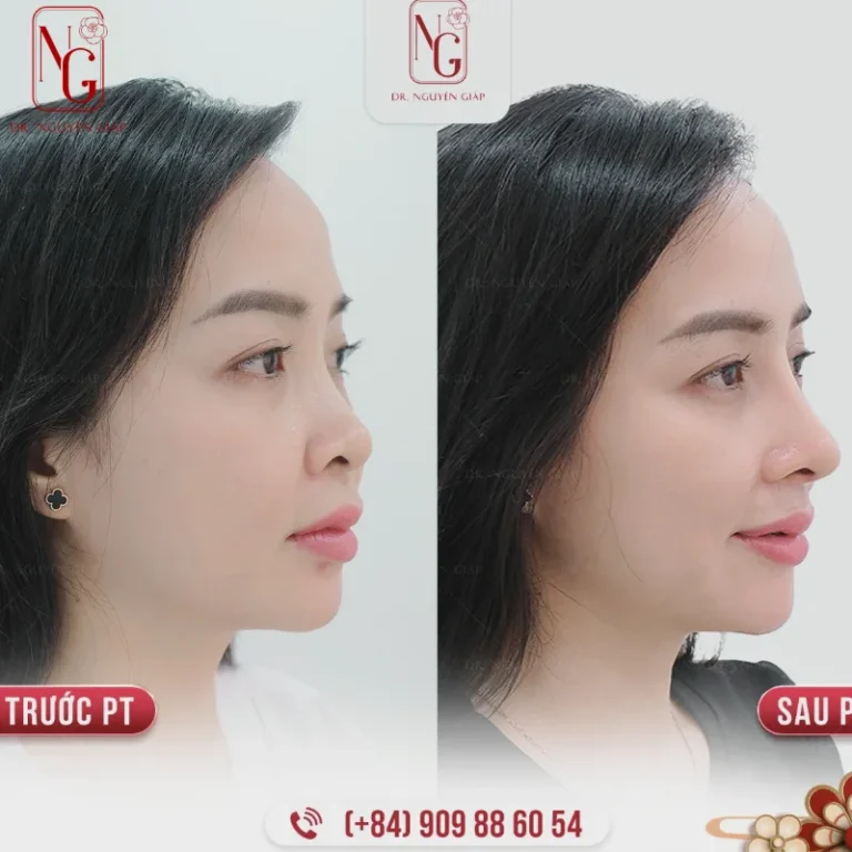 phau thuat chinh sua tuong mui go de cai thien dang mui