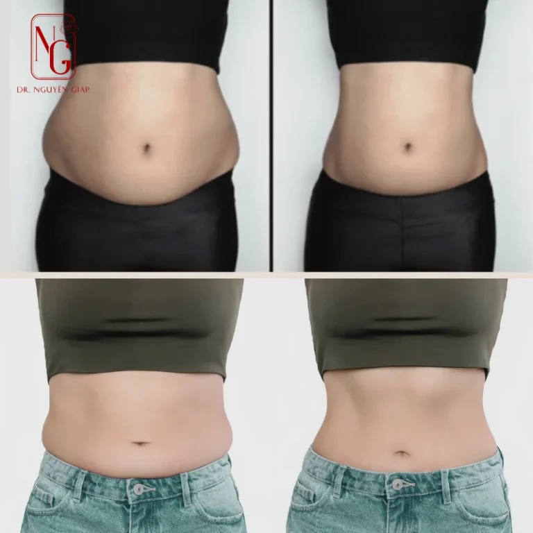 hut mo bung lipo ultrasound voi cong nghe hien dai