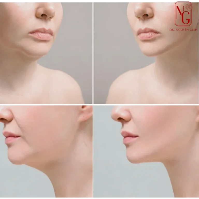 hut mo nong cam la gi