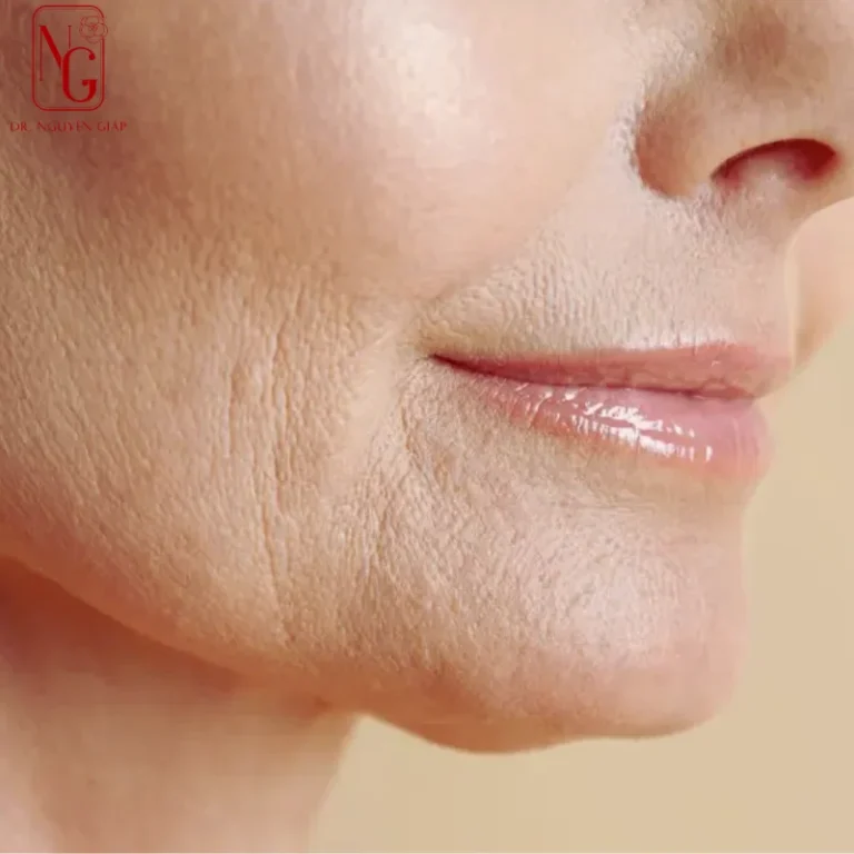 ngan ngua lao hoa da nhu the nao