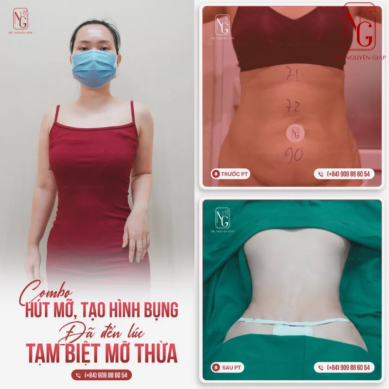 phau thuat death waist gon beautiful