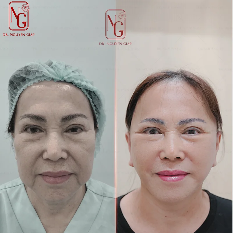 su dung phuong phap cang da mat