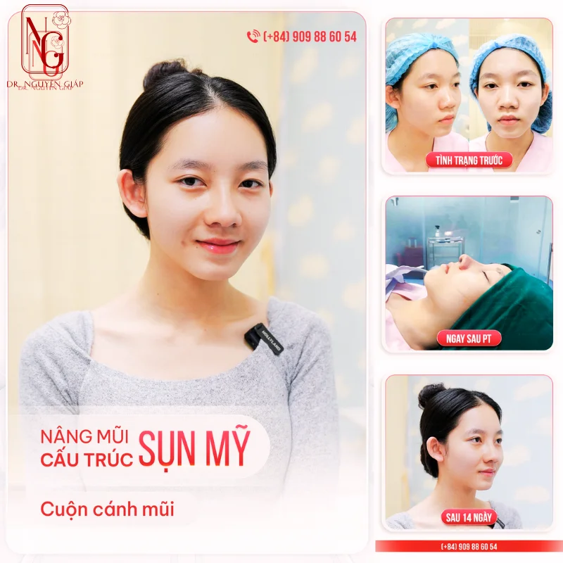 ket qua thu gon canh mui