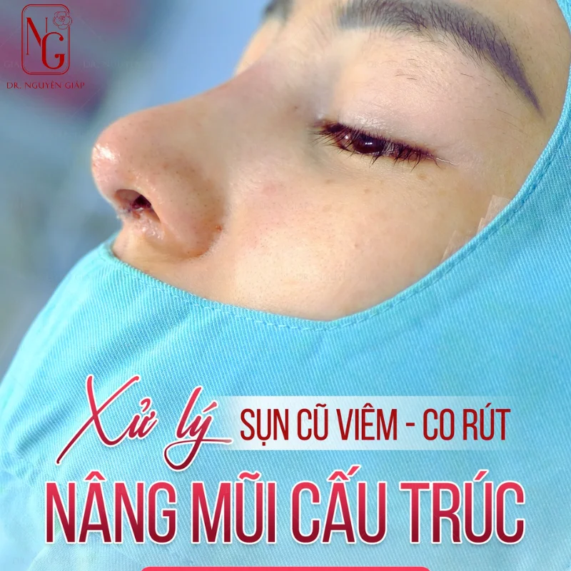 nang mui cau truc cho khach hang