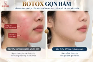 guong-mat-sung-do-va-dau-nhuc-sau-khi-tiem-botox-gon-ham-chinh-hang-dr-nguyen-giap Hình ảnh thực tế guong mat sung do va dau nhuc sau khi tiem botox gon ham chính hãng được cấp phép sử dụng tại Thẩm mỹ Dr Nguyên Giáp