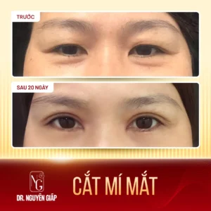 ket-qua-bam-mi-han-quoc-1-thuc-te-dr-nguyen-giap Kết quả khách hàng thực tế bam mi han quoc 1 do trực tiếp Bác sĩ Nguyên Giáp thực hiện