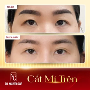 ket-qua-bam-mi-han-quoc-2-thuc-te-dr-nguyen-giap Kết quả khách hàng thực tế bam mi han quoc 2 do trực tiếp Bác sĩ Nguyên Giáp thực hiện