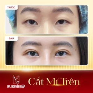 ket-qua-bam-mi-han-quoc-3-thuc-te-dr-nguyen-giap Kết quả khách hàng thực tế bam mi han quoc 3 do trực tiếp Bác sĩ Nguyên Giáp thực hiện