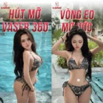 khách hàng thực hiện hút mỡ bắp tay tại DR Nguyên Giáp