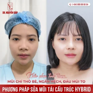 sua mui tai cau truc hybrid