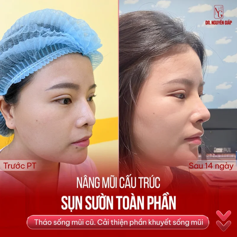 Nên chọn loại sụn mũi nào cho từng tình trạng