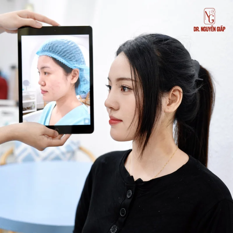 Kết hợp sụn nhân tạo và sụn tự thân