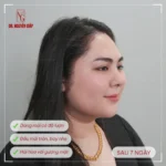 khách hàng hài lòng với dáng mũi sau khi sử dụng sụn