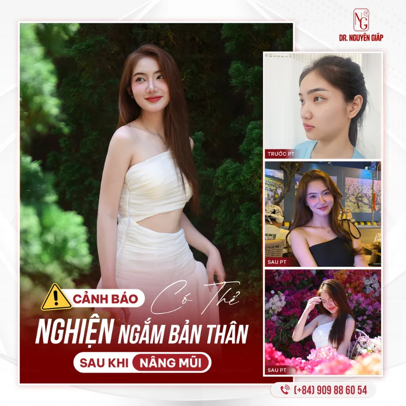 Kinh nghiệm chọn sụn mũi an toàn trước khi phẫu thuật
