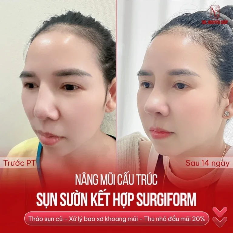 nâng mũi cấu trúc kết hợp sụn surgiform