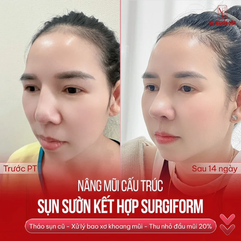 nâng mũi cấu trúc kết hợp sụn surgiform