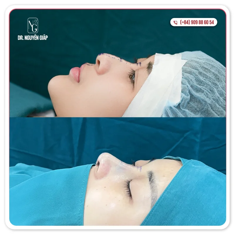 nhóm sụn tự thân lấy từ chính cơ thể