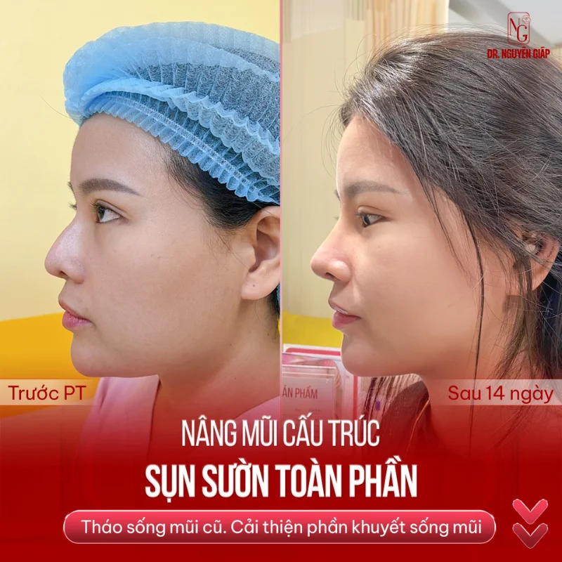 Phương pháp thẩm mỹ giúp nâng sống mũi