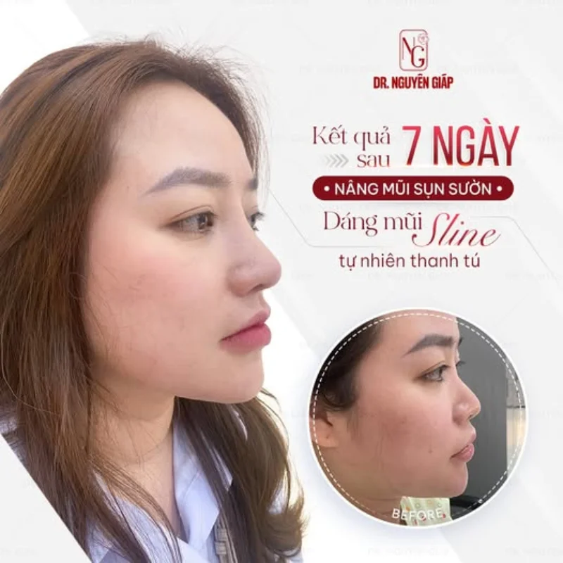 review khách hàng nâng mũi sau 7 ngày
