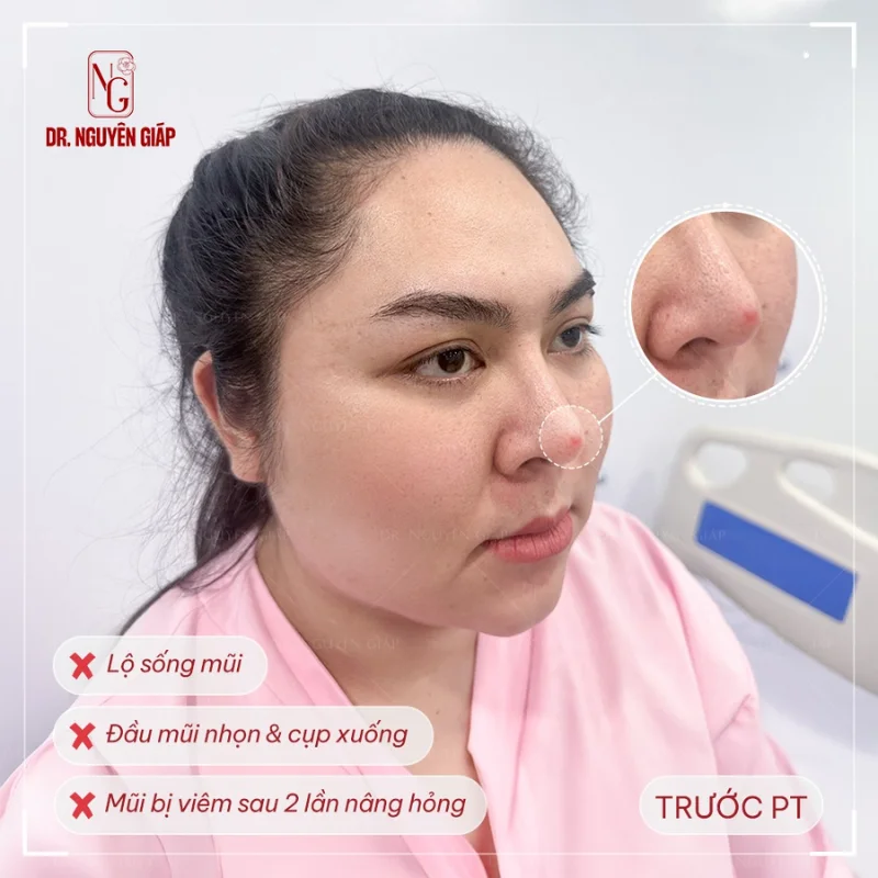 Sụn mũi là gì