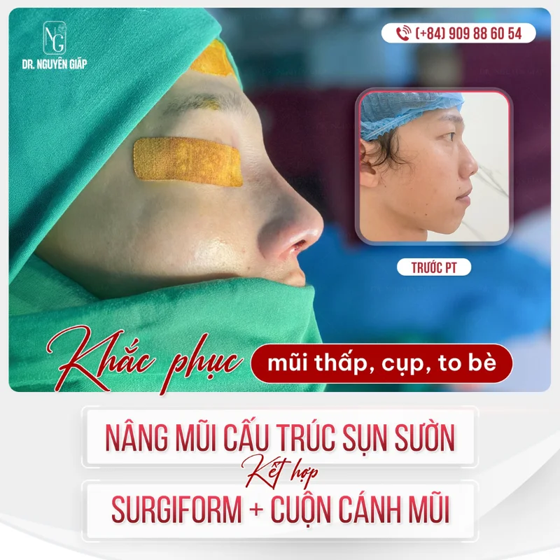 Tiêu chí đánh giá một loại sụn mũi tốt
