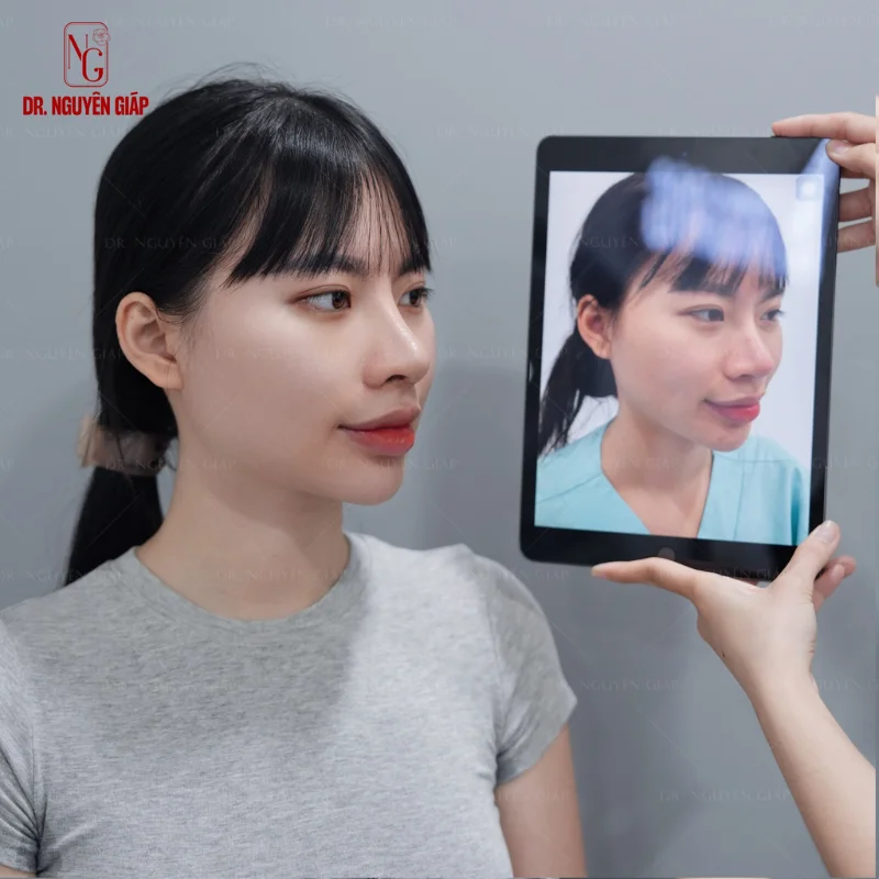 trước và sau khi sử dụng sụn để nâng mũi